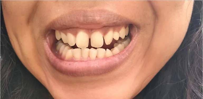 Shiny Smile Veneers