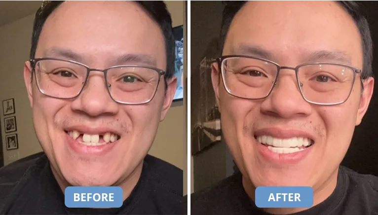 Shiny Smile Veneers