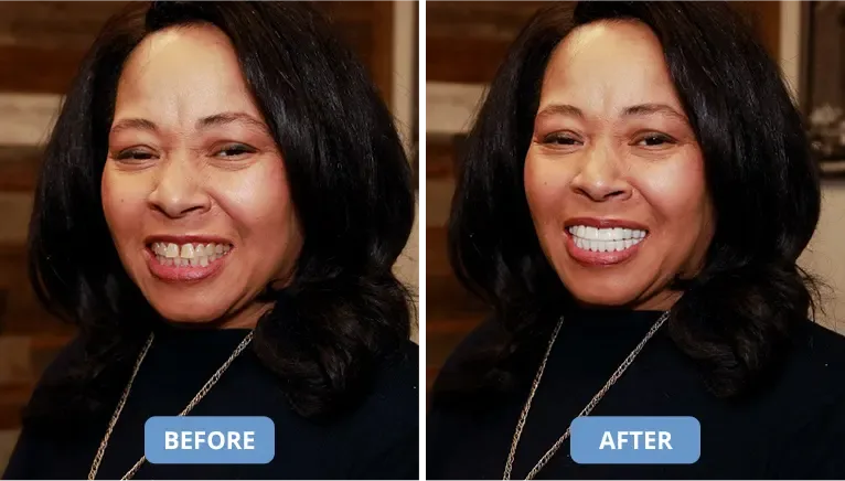 Shiny Smile Veneers
