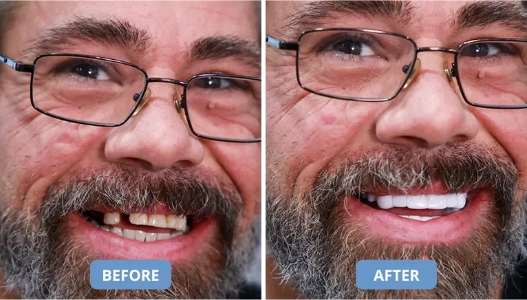Shiny Smile Veneers