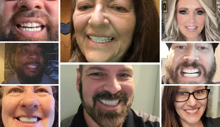 Shiny Smile Veneers