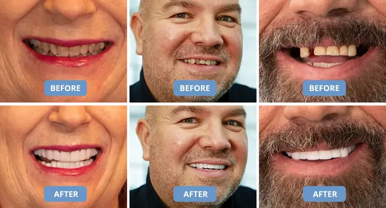 Shiny Smile Veneers