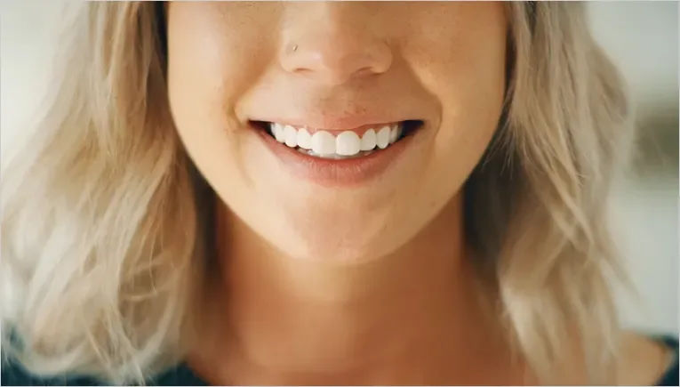 Shiny Smile Veneers