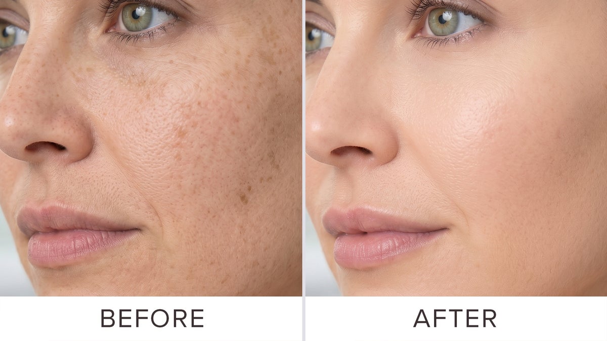 PMD Microderm